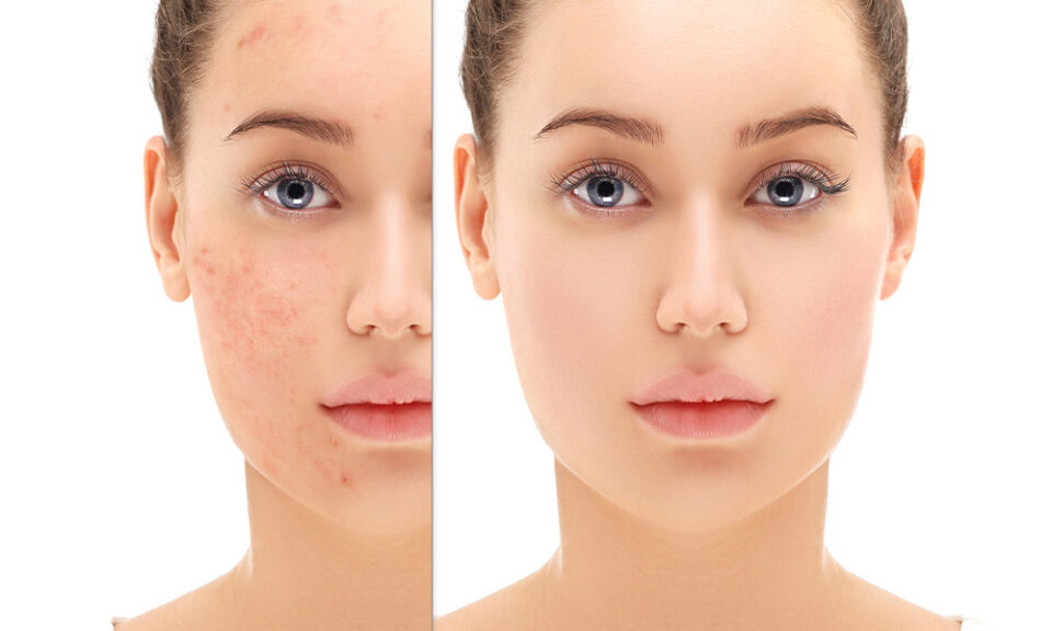 The Best Approaches for Effective Pigmentation Removal